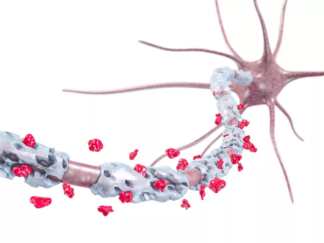 3D illustration demonstrating inflammation and scarring of the myelin sheath