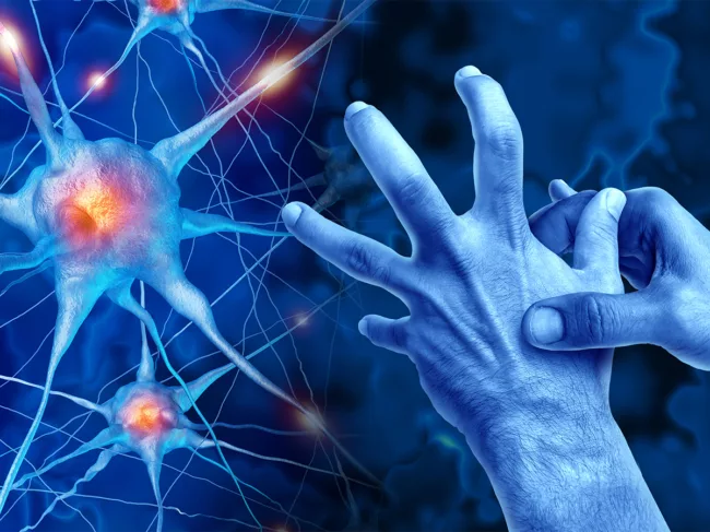 Art concept for Parkinson's disease