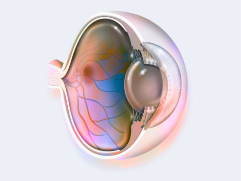 Illustration of the inside of an eye with macular degeneration