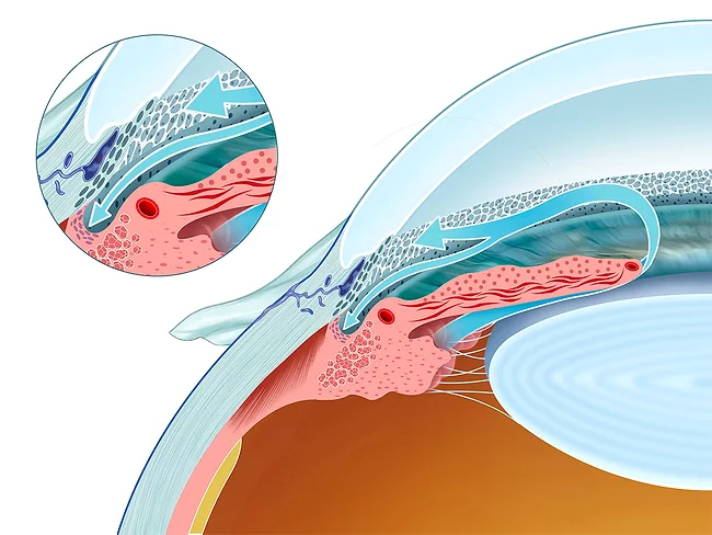Illustration showing aqueous humor drainage from the eye