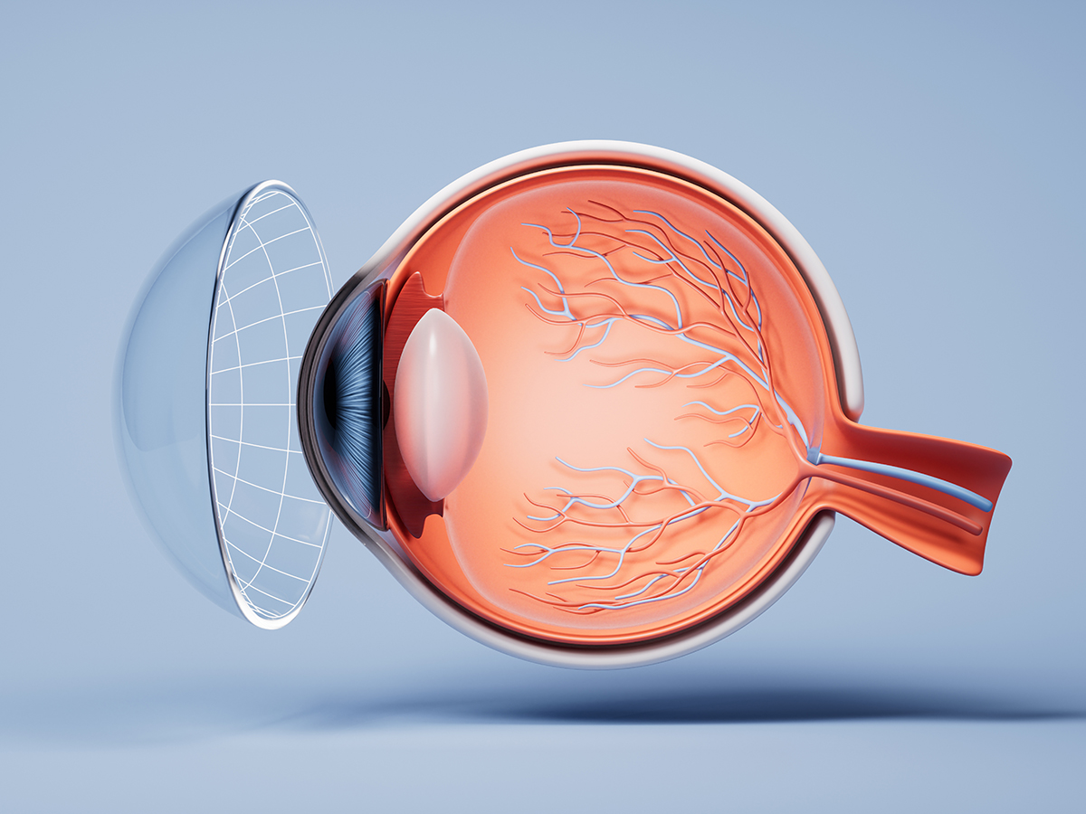 Smart contact lens delivers adaptative glaucoma therapy | BioWorld Smart contact lens delivers adaptative glaucoma therapy | BioWorld
