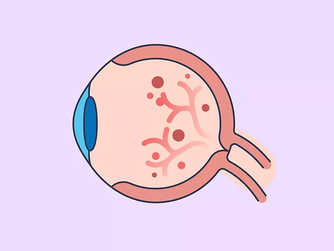 Illustration showing cross section of eye with diabetic retinopathy