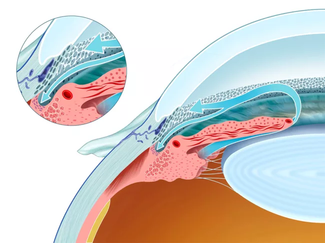 Illustration showing aqueous humor drainage from the eye