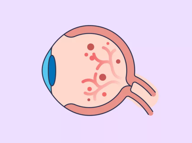 Illustration showing cross section of eye with diabetic retinopathy
