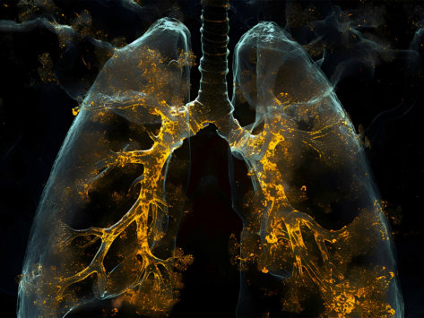 Lung fibrosis ipf