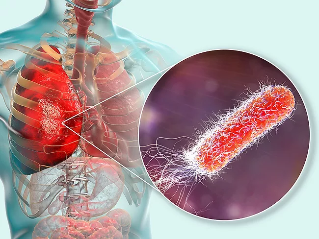Lung infection caused by bacteria Pseudomonas aeruginosa