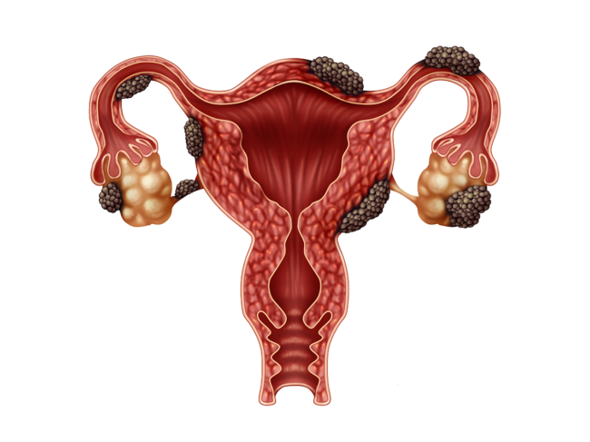 Illustration of ovaries and uterus with endometriosis