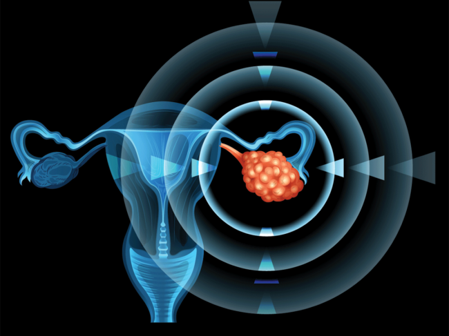 Ovarian cancer illustration