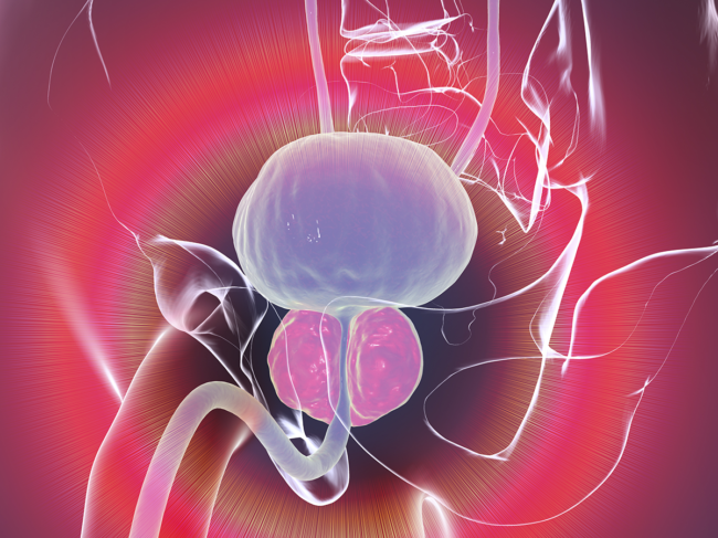 Illustration of human anatomy, enlarged prostate
