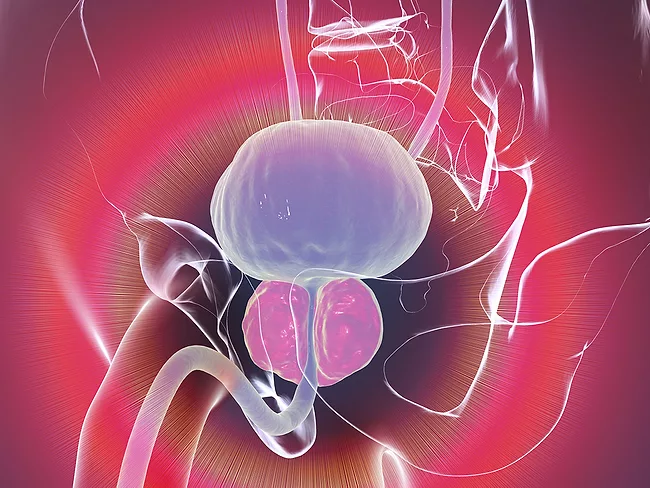 Illustration of human anatomy, enlarged prostate
