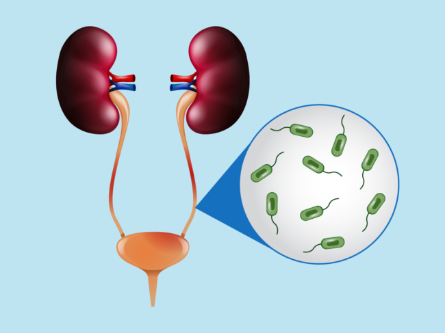 Illustration of infected kidneys, ureter and bladder 