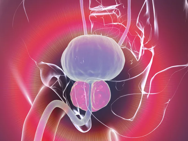Illustration of human anatomy, enlarged prostate