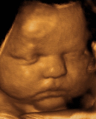A 3-D ultrasound image of a fetus in the womb
